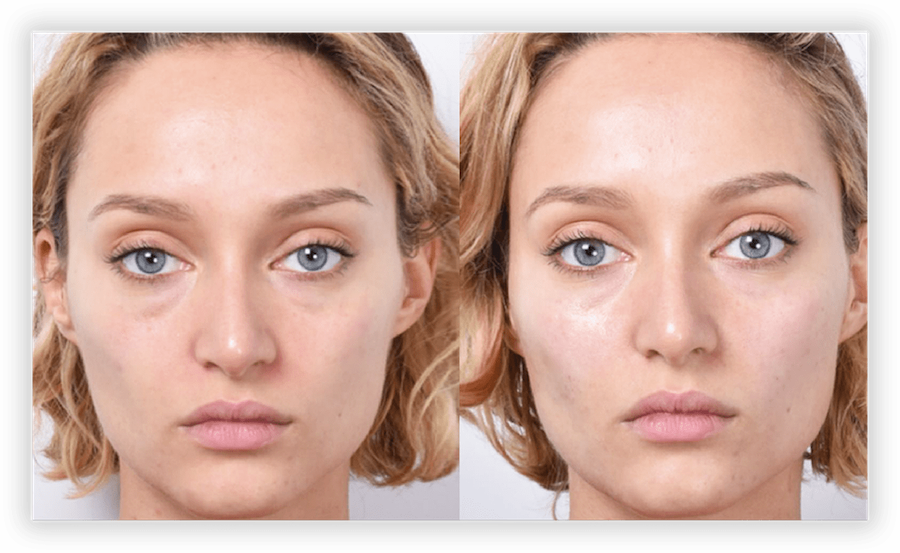 Non Surgical Facelift 2